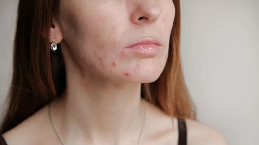 How To Treat and Prevent Maskne - Jevy K-Beauty & Skincare